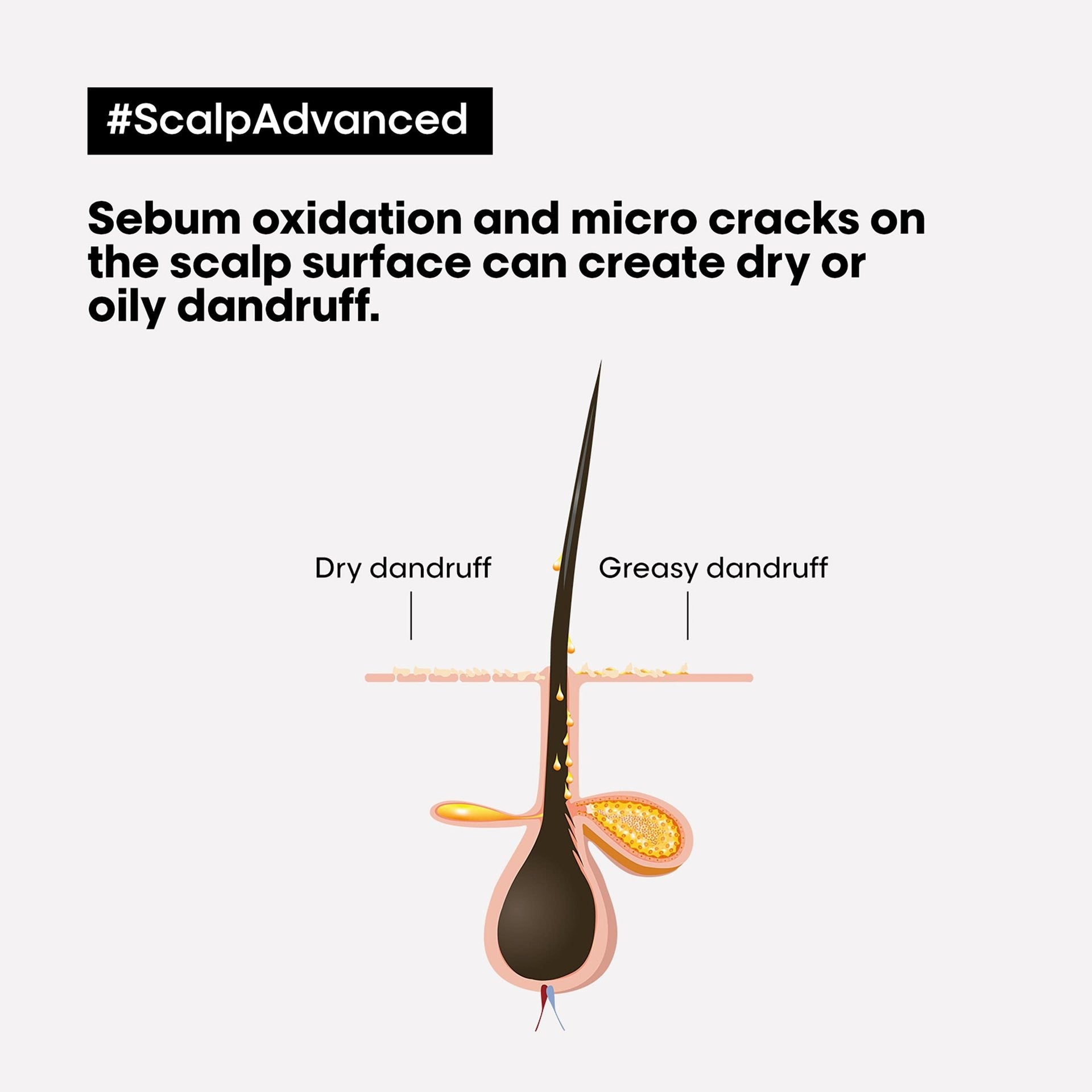 L'Oréal Professionnel Scalp Advanced Anti-pelliculaire Dermo-Clarifiant Élimine les Pellicules